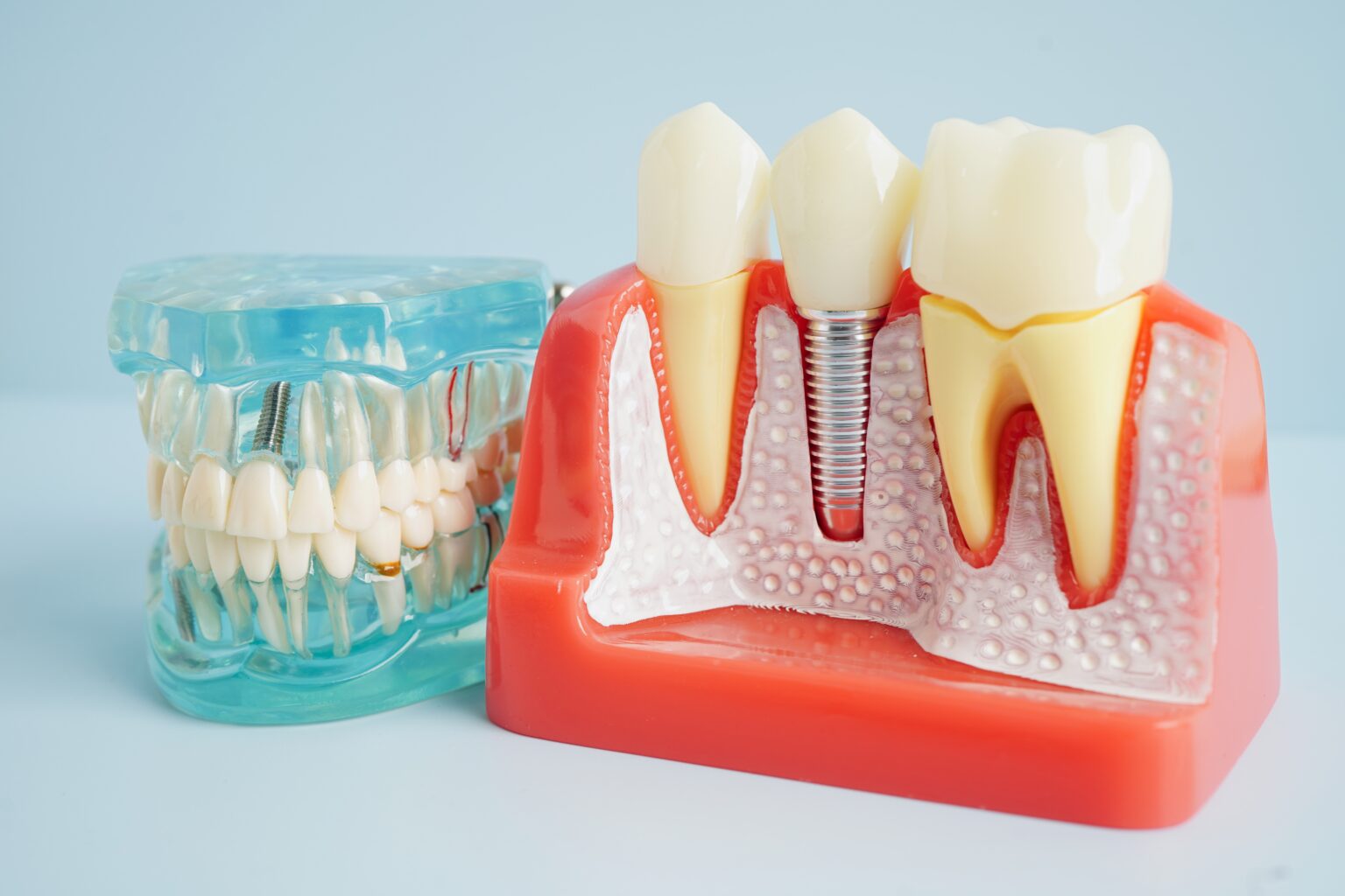 Dental Implants Temecula